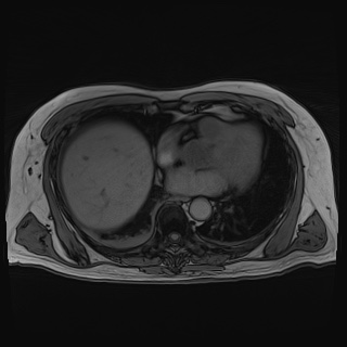 File:Acute cholecystitis (Radiopaedia 72392-82923 Axial T1 out-of-phase 14).jpg