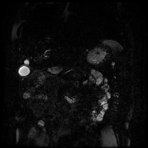 Acute cholecystitis and biliary hamartomas (Radiopaedia 86231-102240 E 115).jpg