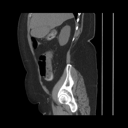Acute cholecystitis with tensile fundus sign (Radiopaedia 71394-81723 Sagittal non-contrast 59).jpg