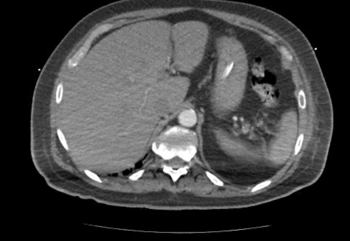 Acute cor pulmonale (ultrasound) (Radiopaedia 83508-98818 Axial C+ CTPA 83).jpg