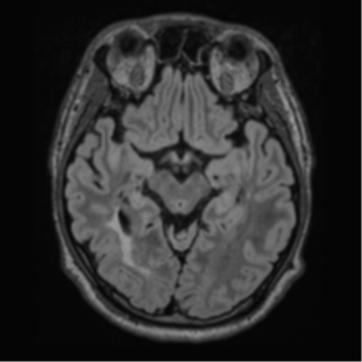 Acute disseminated encephalomyelitis (ADEM)- Anti-NMDA receptor encephalitis (Radiopaedia 54920-61201 Axial FLAIR 28).png