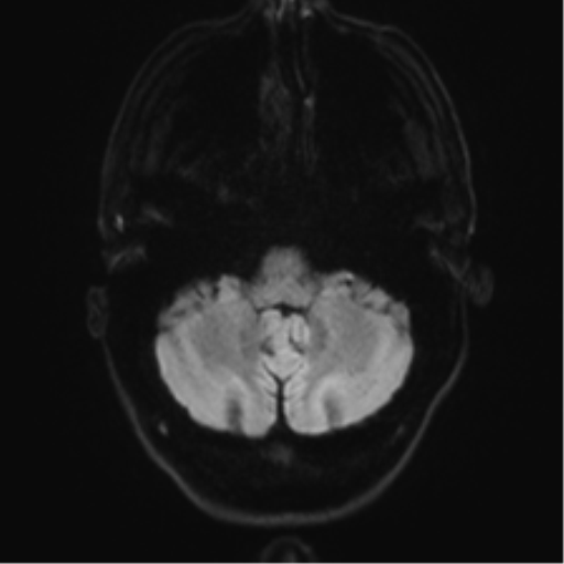 File:Acute disseminated encephalomyelitis (ADEM) (Radiopaedia 65319-74350 Axial DWI 4).png
