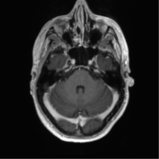 Acute disseminated encephalomyelitis (ADEM) (Radiopaedia 65319-74350 Axial T1 C+ 12).png