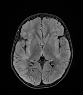 File:Acute disseminating encephalomyelitis with bilateral optic neuritis (Radiopaedia 79676-92886 Axial FLAIR 13).jpg