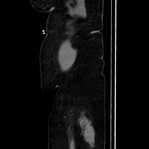 Acute diverticulitis - transverse colon (Radiopaedia 87063-103327 Sagittal C+ portal venous phase 41).jpg