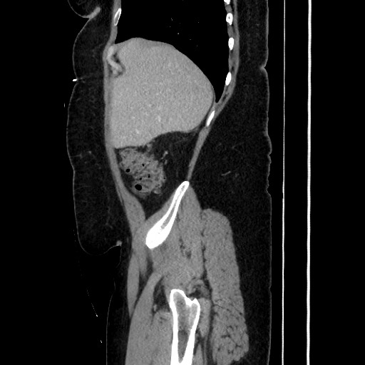 Acute diverticulitis - transverse colon (Radiopaedia 87063-103327 Sagittal C+ portal venous phase 68).jpg