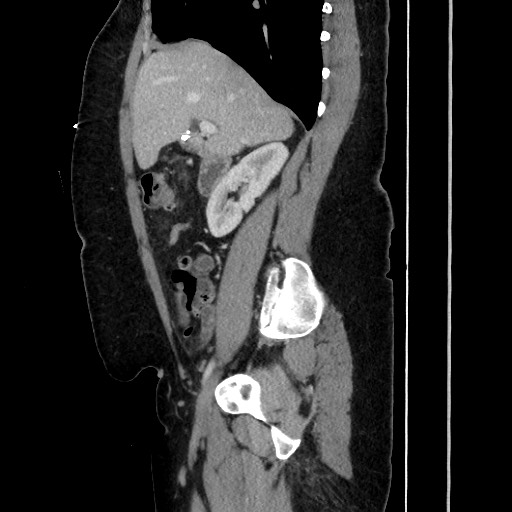 Acute diverticulitis - transverse colon (Radiopaedia 87063-103327 Sagittal C+ portal venous phase 94).jpg