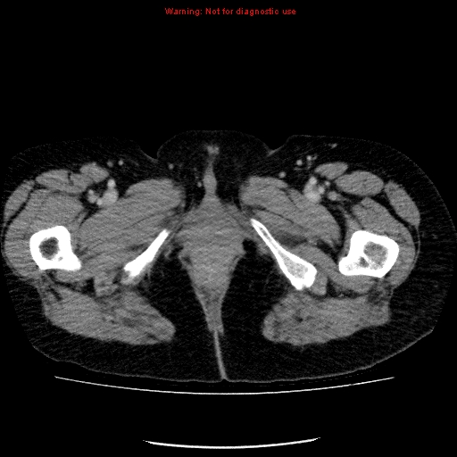 Acute gangrenous cholecystitis (Radiopaedia 10123-10661 Axial C+ portal venous phase 110).jpg
