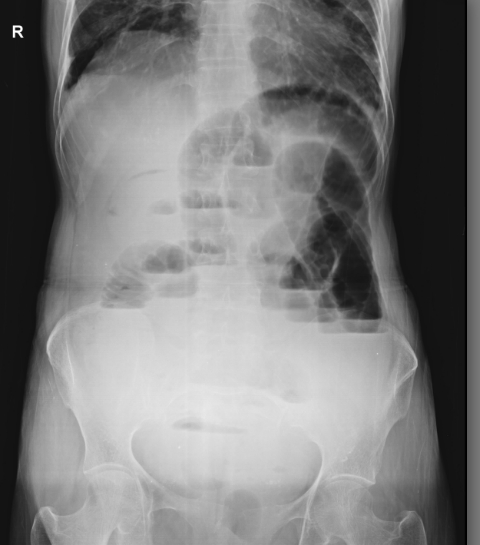 File:Acute intestinal obstruction (Radiopaedia 25877).jpg