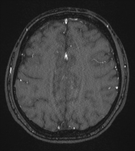 Acute left middle cerebral artery territory infarct with clot retrieval (Radiopaedia 47732-52433 Axial MRA 48).png