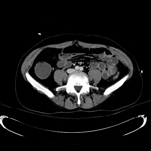 Acute myocardial infarction in CT (Radiopaedia 39947-42415 Axial C+ portal venous phase 82).jpg
