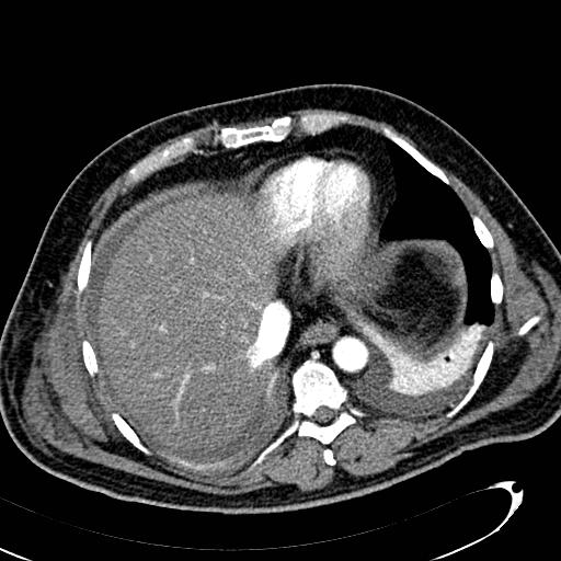 File:Acute pancreatic necrosis (Radiopaedia 13560-13486 Axial C+ portal venous phase 22).jpg