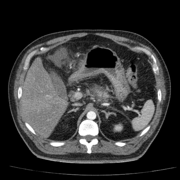 Acute pancreatitis (Radiopaedia 26663-26813 Axial C+ arterial phase 30).jpg