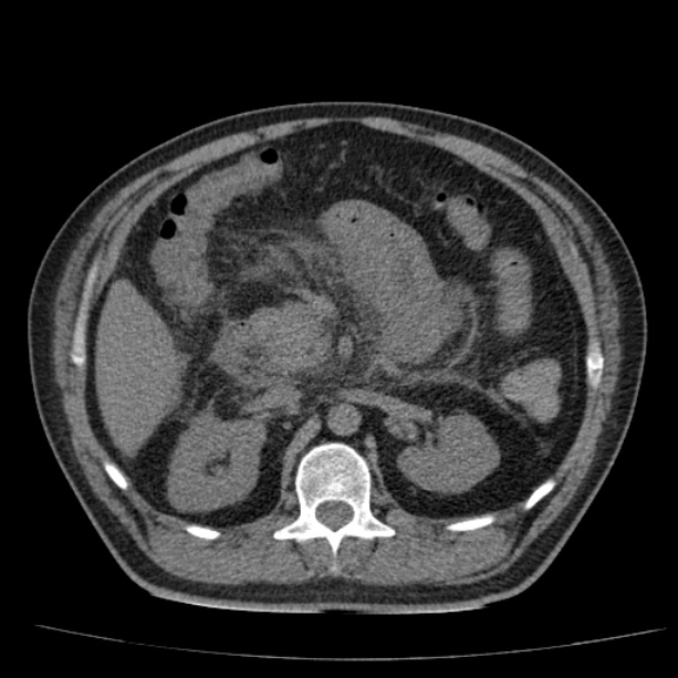 Acute pancreatitis (Radiopaedia 26663-26813 Axial non-contrast 40).jpg