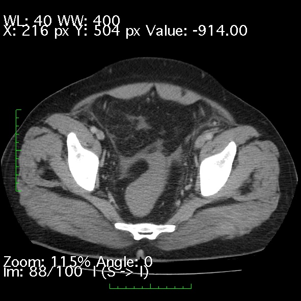 Acute pancreatitis (Radiopaedia 34043-35276 Axial C+ portal venous phase 88).jpg