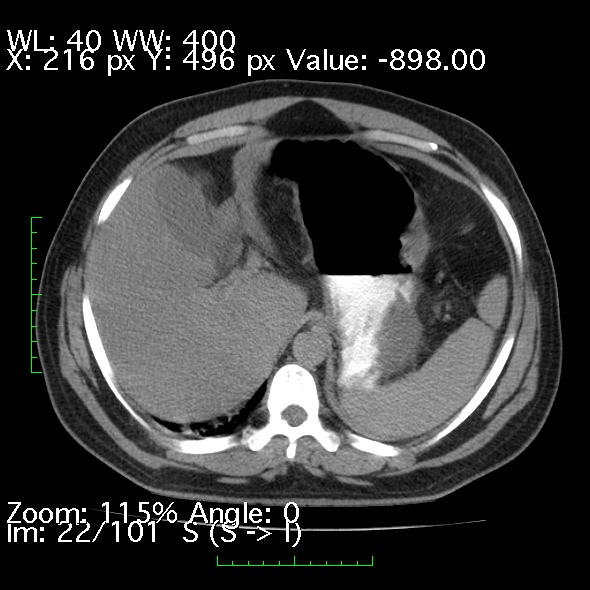 Acute pancreatitis (Radiopaedia 34043-35276 Axial non-contrast 22).jpg