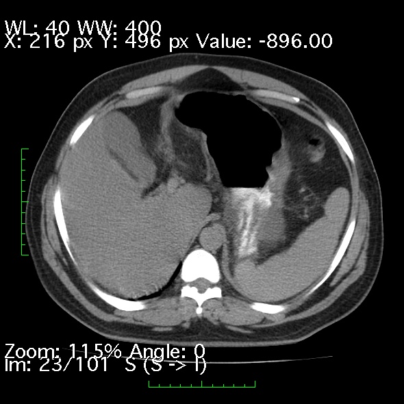 File:Acute pancreatitis (Radiopaedia 34043-35276 Axial non-contrast 23).jpg