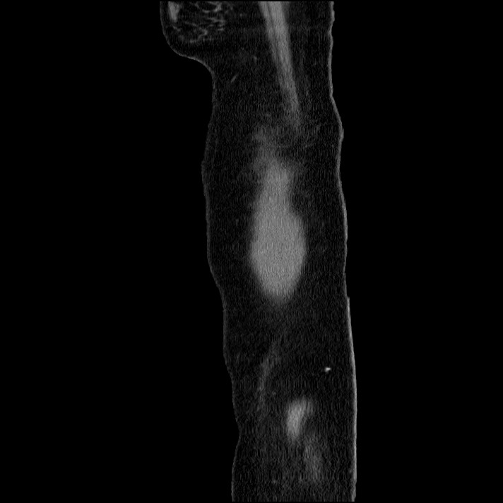 Acute pancreatitis (Radiopaedia 69236-79012 Sagittal C+ portal venous phase 91).jpg