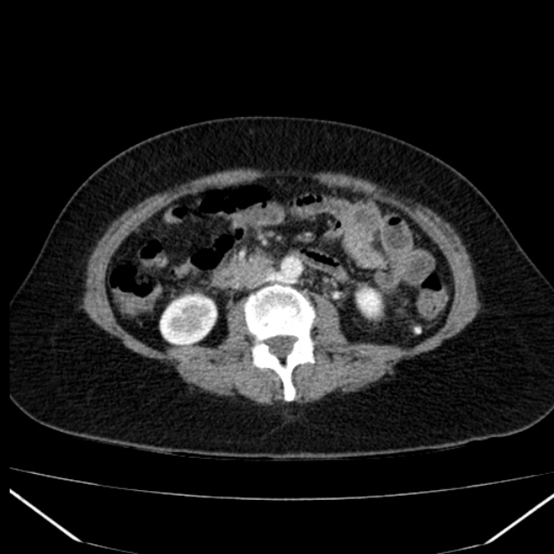 Acute pancreatitis - Balthazar C (Radiopaedia 26569-26714 Axial C+ arterial phase 47).jpg
