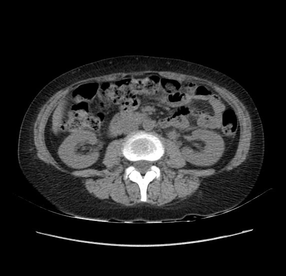 File:Acute pancreatitis - Balthazar E - post ERCP (Radiopaedia 27562-27772 Axial non-contrast 31).png