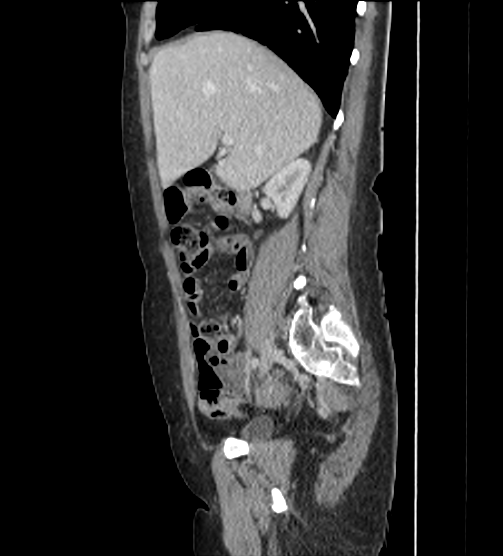 File:Acute pancreatitis - Balthazar E - post ERCP (Radiopaedia 27562-27772 Sagittal C+ portal venous phase 42).png