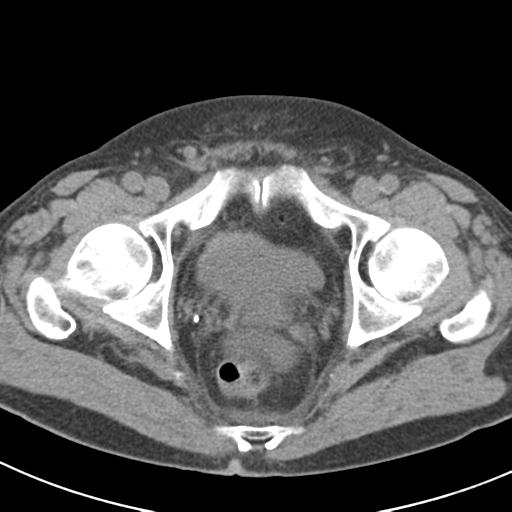 File:Acute pancreatitis and walled-off necrosis (Radiopaedia 29888-30403 Axial non-contrast 73).jpg