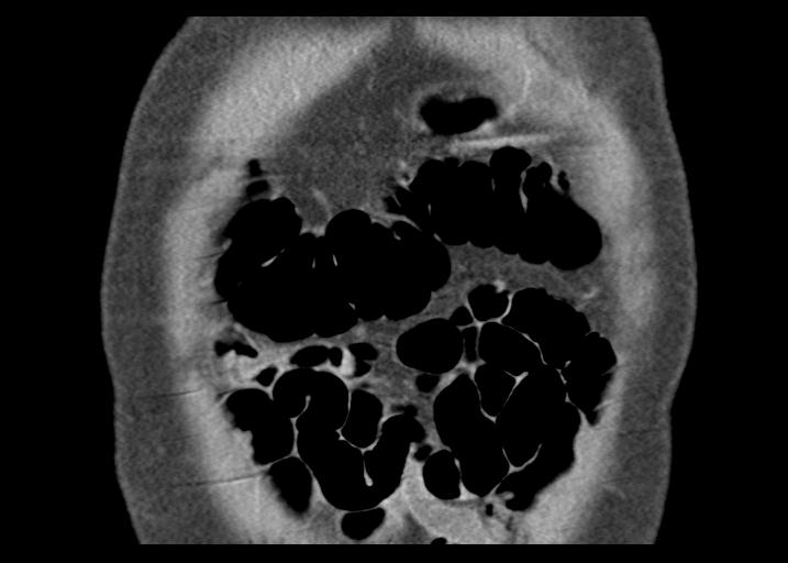 Acute pancreatitis and walled-off necrosis (Radiopaedia 29888-30403 Coronal C+ portal venous phase 10).jpg
