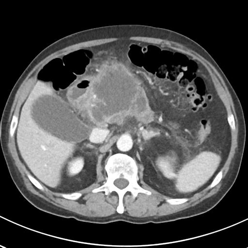 File:Acute pancreatitis and walled-off necrosis (Radiopaedia 29888-30404 Axial C+ portal venous phase 27).jpg