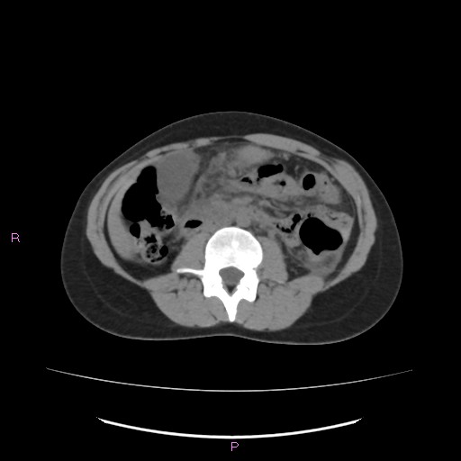 Acute pancreatitis secondary to stone at minor papilla and pancreatic divisum (Radiopaedia 76570-88333 Axial non-contrast 36).jpg