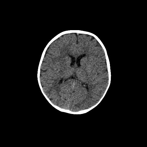 Acute phase of hemiconvulsion-hemiplegia epilepsy syndrome (Radiopaedia 29309-29744 Axial non-contrast 23).jpg