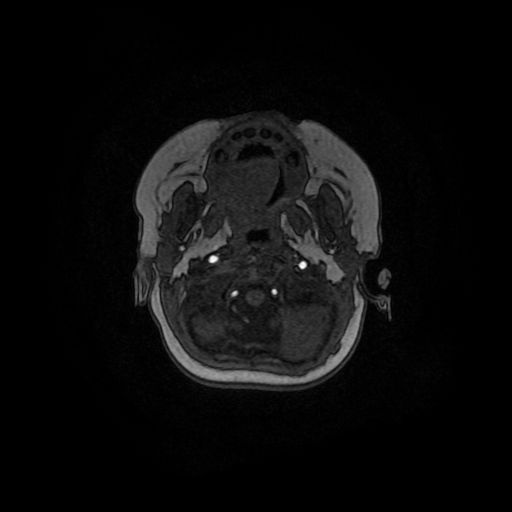 File:Acute phase of hemiconvulsion-hemiplegia epilepsy syndrome (Radiopaedia 29309-29745 Axial TOF angiography 151).jpg