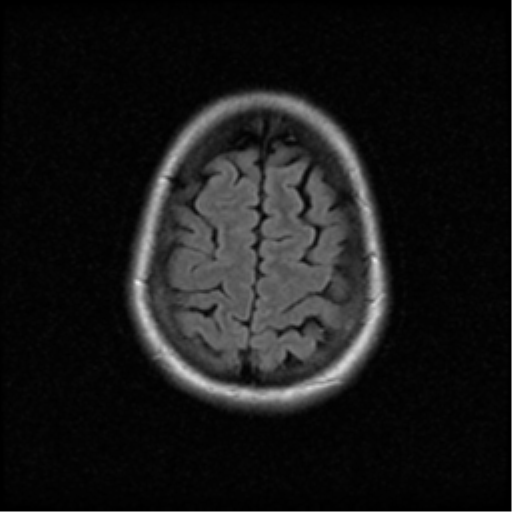 File:Acute pontine infarct from vertebral artery dissection (Radiopaedia 34111-35370 Axial FLAIR 19).png