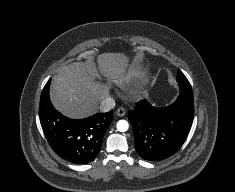 Acute pulmonary embolism with pulmonary infarcts (Radiopaedia 77688-89908 Axial C+ CTPA 53).jpg