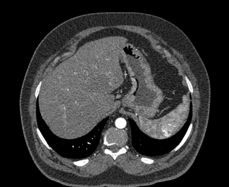 Acute pulmonary embolism with pulmonary infarcts (Radiopaedia 77688-89908 Axial C+ CTPA 63).jpg