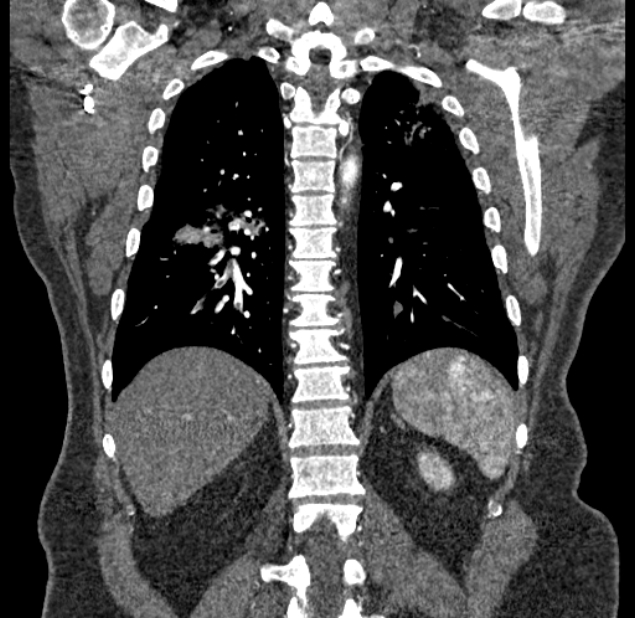 Acute pulmonary embolism with pulmonary infarcts (Radiopaedia 77688-89908 Coronal C+ CTPA 75).jpg
