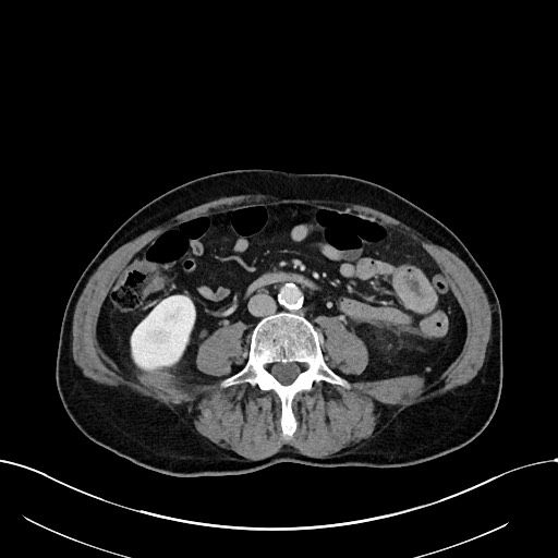 File:Acute renal infarction (Radiopaedia 59375-66736 Axial C+ portal venous phase 59).jpg
