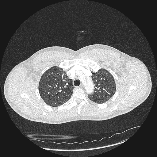 Acute segmental pulmonary emboli and pulmonary infarction (Radiopaedia 62264-70444 Axial lung window 44).jpg