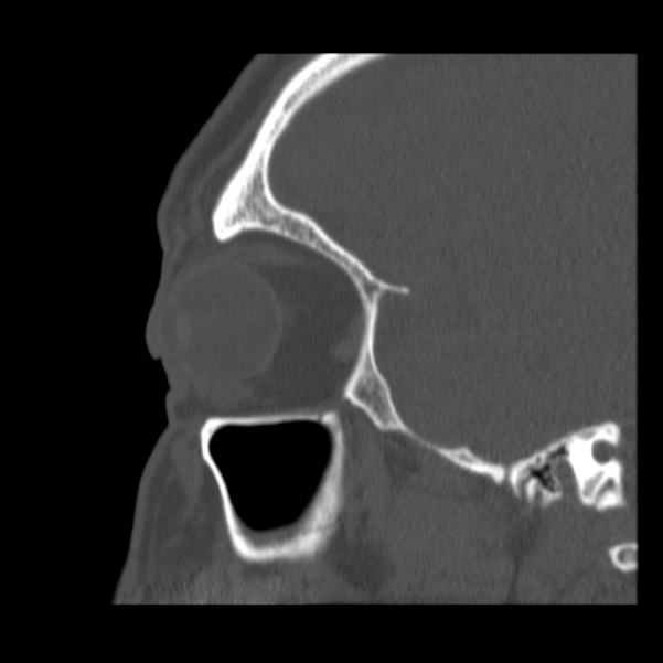 Acute sinusitis (Radiopaedia 23161-23215 Sagittal bone window 49).jpg