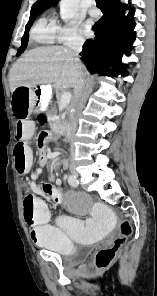 Acute small bowel (ileal) volvulus (Radiopaedia 71740-82139 Sagittal C+ portal venous phase 95).jpg