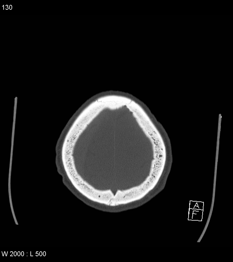 Acute subdural hematoma with myelofibrosis (Radiopaedia 52582-58494 Axial bone window 65).jpg