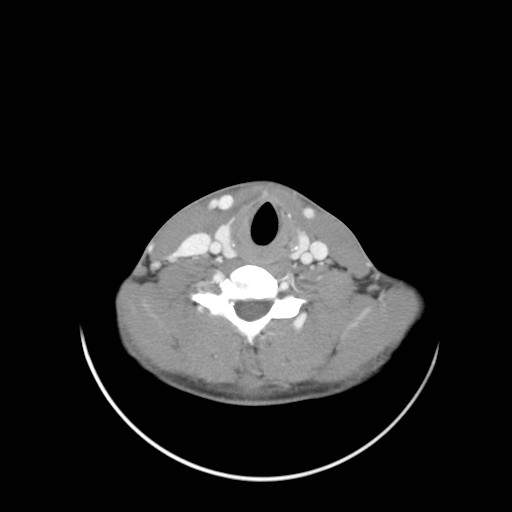 File:Acute submandibular sialadenitis secondary to ductal stone (Radiopaedia 27999-28267 Axial C+ delayed 35).jpg