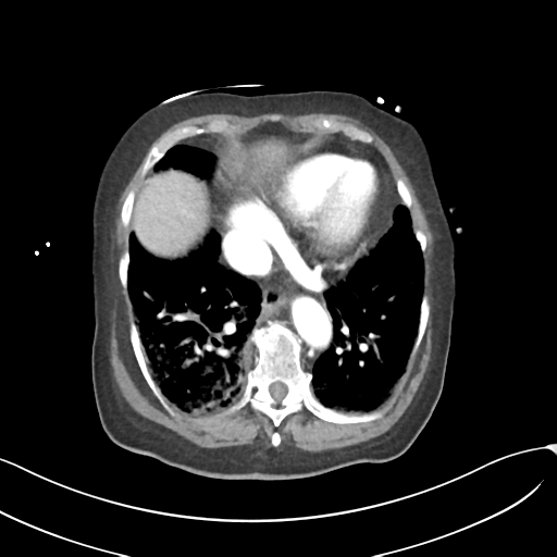 Acute superior mesenteric artery occlusion (Radiopaedia 43926-47418 Axial C+ portal venous phase 7).png