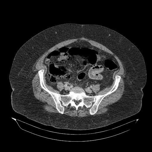 Acute superior mesenteric artery occlusion (Radiopaedia 51288-56960 Axial C+ portal venous phase 75).jpg