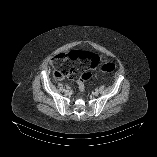Acute superior mesenteric artery occlusion (Radiopaedia 51288-56960 Axial C+ portal venous phase 79).jpg