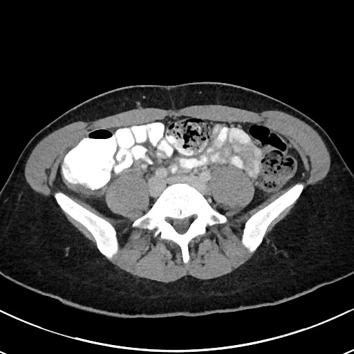 Acute uncomplicated appendicitis (Radiopaedia 61374-69304 Axial C+ portal venous phase 77).jpg