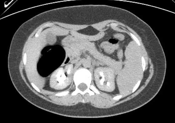 Acute unilateral nonhemorrhagic adrenal infarction (Radiopaedia 67560-76957 Axial renal excretory phase 43).jpg