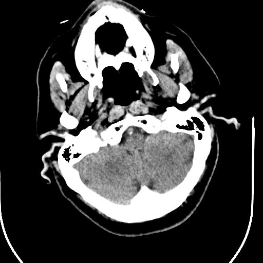 Acute vertebrobasilar ischemic infarction (Radiopaedia 25220-25473 Axial non-contrast 11).jpg