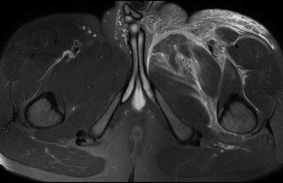 File:Adductor longus tear with retraction (Radiopaedia 56424-63103 Axial T2 fat sat 26).jpg