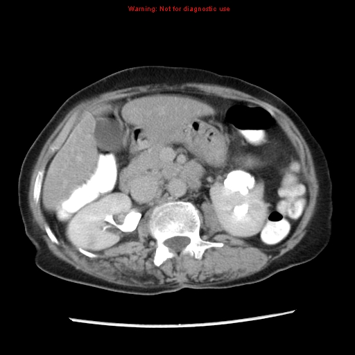 File:Adenocarcinoma of the colon (Radiopaedia 8191-9039 Axial renal excretory phase 16).jpg