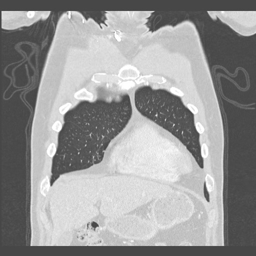 Adenocarcinoma of the lung (Radiopaedia 59871-67325 Coronal lung window 6).jpg